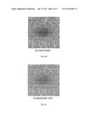 AUTOMATIC THREE-DIMENSIONAL SEGMENTATION METHOD FOR OCT AND DOPPLER OCT     ANGIOGRAPHY diagram and image