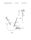 URETHRAL CATHETERLESS RADICAL PROSTATECTOMY diagram and image