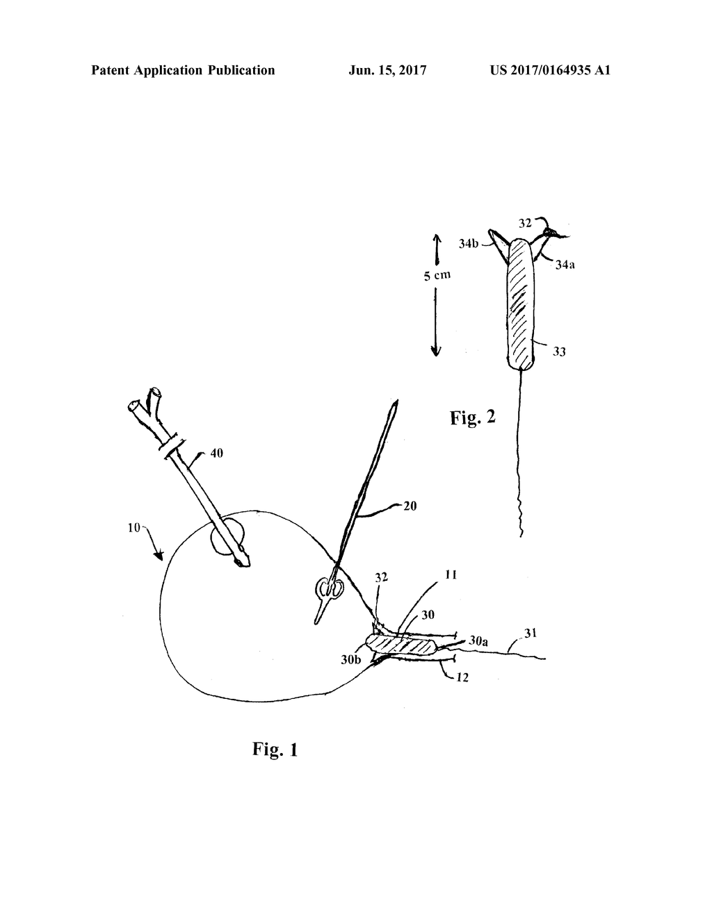 URETHRAL CATHETERLESS RADICAL PROSTATECTOMY - diagram, schematic, and image 02