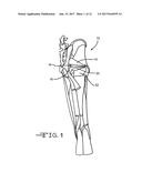 RETRACTOR TOOLS FOR MINIMALLY INVASIVE HIP SURGERY diagram and image