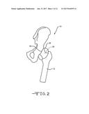 RETRACTOR TOOLS FOR MINIMALLY INVASIVE HIP SURGERY diagram and image