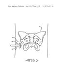 RETRACTOR TOOLS FOR MINIMALLY INVASIVE HIP SURGERY diagram and image