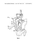 ASSOCIATED INSTRUMENTS AND METHODS FOR POSTERIOR STABILIZED KNEE     PREPARATION diagram and image