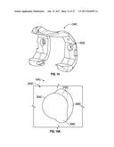 ASSOCIATED INSTRUMENTS AND METHODS FOR POSTERIOR STABILIZED KNEE     PREPARATION diagram and image