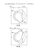 ASSOCIATED INSTRUMENTS AND METHODS FOR POSTERIOR STABILIZED KNEE     PREPARATION diagram and image