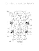 Percutaneous Pedicle Screw Revision System diagram and image