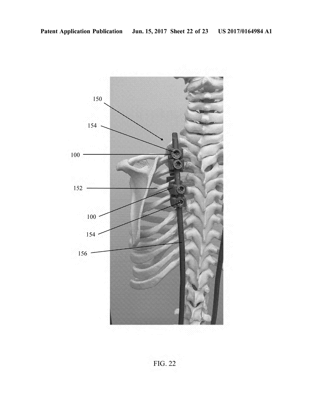 RIB HOOK DEVICES, SYSTEMS, AND METHODS OF USE - diagram, schematic, and image 23