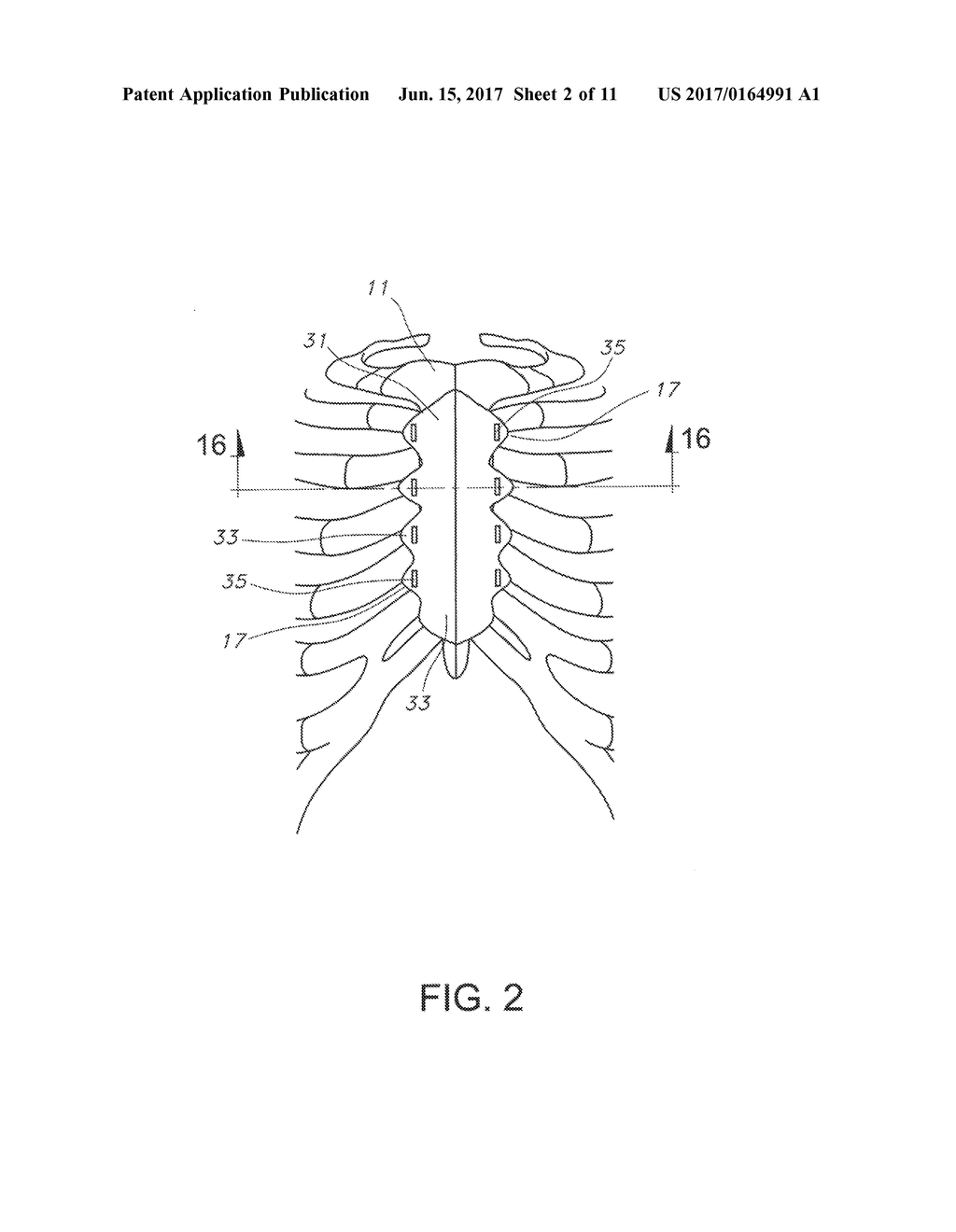 Sternum Fixation Device and Method - diagram, schematic, and image 03