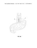 Method and Apparatus for Tissue Ablation diagram and image