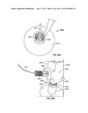 Method and Apparatus for Tissue Ablation diagram and image