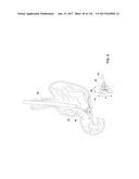 Method and Apparatus for Tissue Ablation diagram and image