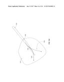 Method and Apparatus for Tissue Ablation diagram and image