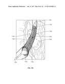 Method and Apparatus for Tissue Ablation diagram and image