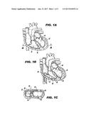 METHOD AND DEVICE FOR PERCUTANEOUS LEFT VENTRICULAR RECONSTRUCTION diagram and image