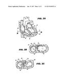 METHOD AND DEVICE FOR PERCUTANEOUS LEFT VENTRICULAR RECONSTRUCTION diagram and image