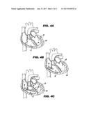 METHOD AND DEVICE FOR PERCUTANEOUS LEFT VENTRICULAR RECONSTRUCTION diagram and image