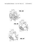 METHOD AND DEVICE FOR PERCUTANEOUS LEFT VENTRICULAR RECONSTRUCTION diagram and image