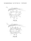 DRY EYE TREATMENT SYSTEMS diagram and image