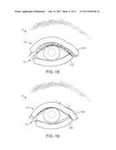 DRY EYE TREATMENT SYSTEMS diagram and image