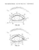 DRY EYE TREATMENT SYSTEMS diagram and image