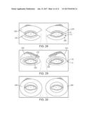 DRY EYE TREATMENT SYSTEMS diagram and image