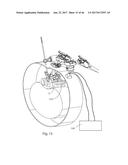 LATERAL ACCESS SYSTEM FOR THE LUMBAR SPINE diagram and image