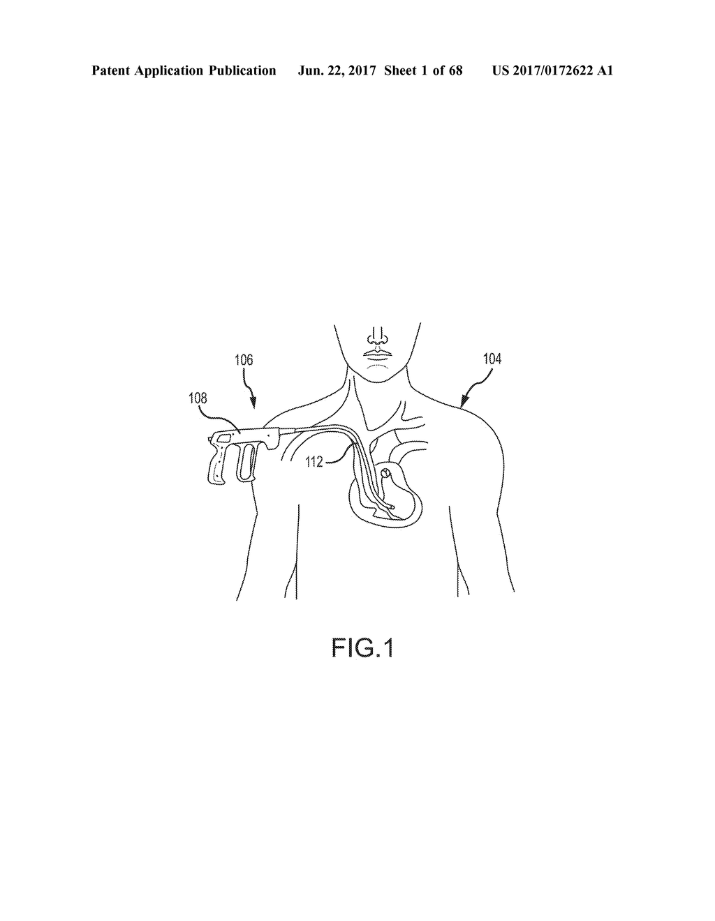 MEDICAL DEVICE FOR REMOVING AN IMPLANTED OBJECT - diagram, schematic, and image 02