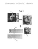 SPATIAL VISUALIZATION OF INTERNAL MAMMARY ARTERY DURING MINIMALLY INVASIVE     BYPASS SURGERY diagram and image