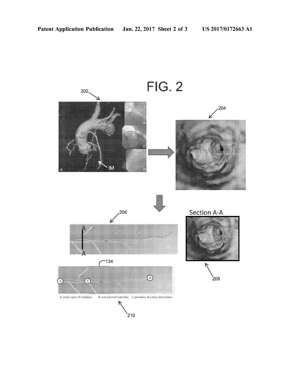 SPATIAL VISUALIZATION OF INTERNAL MAMMARY ARTERY DURING MINIMALLY INVASIVE     BYPASS SURGERY - diagram, schematic, and image 03