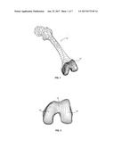 EXTENDED PATELLOFEMORAL diagram and image