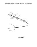 Stent And Stent Delivery Device diagram and image