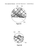 Stent And Stent Delivery Device diagram and image