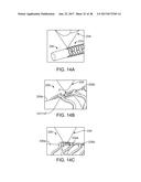 THIN-WALLED SCAFFOLDS HAVING REDUCED CRIMP PROFILE AND CARRYING RADIOPAQUE     MARKERS. diagram and image