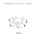 TWO-PART NON-PLANAR GRADUATED COMPRESSION DEVICE FOR THE TREATMENT OF     CIRCULATORY DISORDERS diagram and image