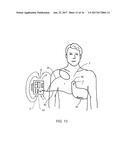 CPR ASSIST DEVICE FOR MEASURING COMPRESSION PARAMETERS DURING     CARDIOPULMONARY RESUSCITATION diagram and image