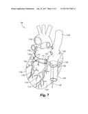 CATHETER SYSTEMS AND METHODS USEFUL FOR CELL THERAPY diagram and image