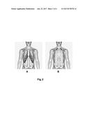 SILHOUETTE DISPLAY FOR VISUAL ASSESSMENT OF CALCIFIED RIB-CARTILAGE JOINTS diagram and image