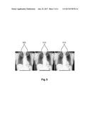 SILHOUETTE DISPLAY FOR VISUAL ASSESSMENT OF CALCIFIED RIB-CARTILAGE JOINTS diagram and image