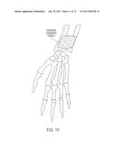 WRIST PLATE AND DRILL GUIDE diagram and image