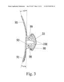 General anatomic self-locking plate for medial acetabulum and auxiliary     apparatus thereof diagram and image