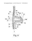 General anatomic self-locking plate for medial acetabulum and auxiliary     apparatus thereof diagram and image