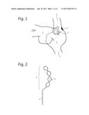 LIMITED ABLATION FOR THE TREATMENT OF SICK SINUS SYNDROME AND OTHER     INAPPROPRIATE SINUS BRADYCARDIAS diagram and image