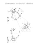 LIMITED ABLATION FOR THE TREATMENT OF SICK SINUS SYNDROME AND OTHER     INAPPROPRIATE SINUS BRADYCARDIAS diagram and image