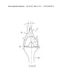 KNEE IMPLANT METHODS AND SYSTEMS diagram and image