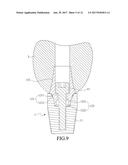 DENTAL IMPLANT ASSEMBLY AND ABUTMENT THEREOF diagram and image