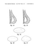 DEVICES, SYSTEMS AND METHODS FOR USING AND MONITORING IMPLANTS diagram and image