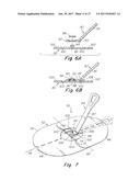 DEPLOYMENT DEVICE FOR A SOFT TISSUE REPAIR PROSTHESIS diagram and image