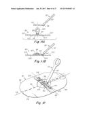 DEPLOYMENT DEVICE FOR A SOFT TISSUE REPAIR PROSTHESIS diagram and image