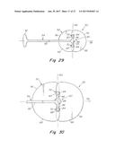 DEPLOYMENT DEVICE FOR A SOFT TISSUE REPAIR PROSTHESIS diagram and image