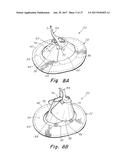 DEPLOYMENT DEVICE FOR A SOFT TISSUE REPAIR PROSTHESIS diagram and image